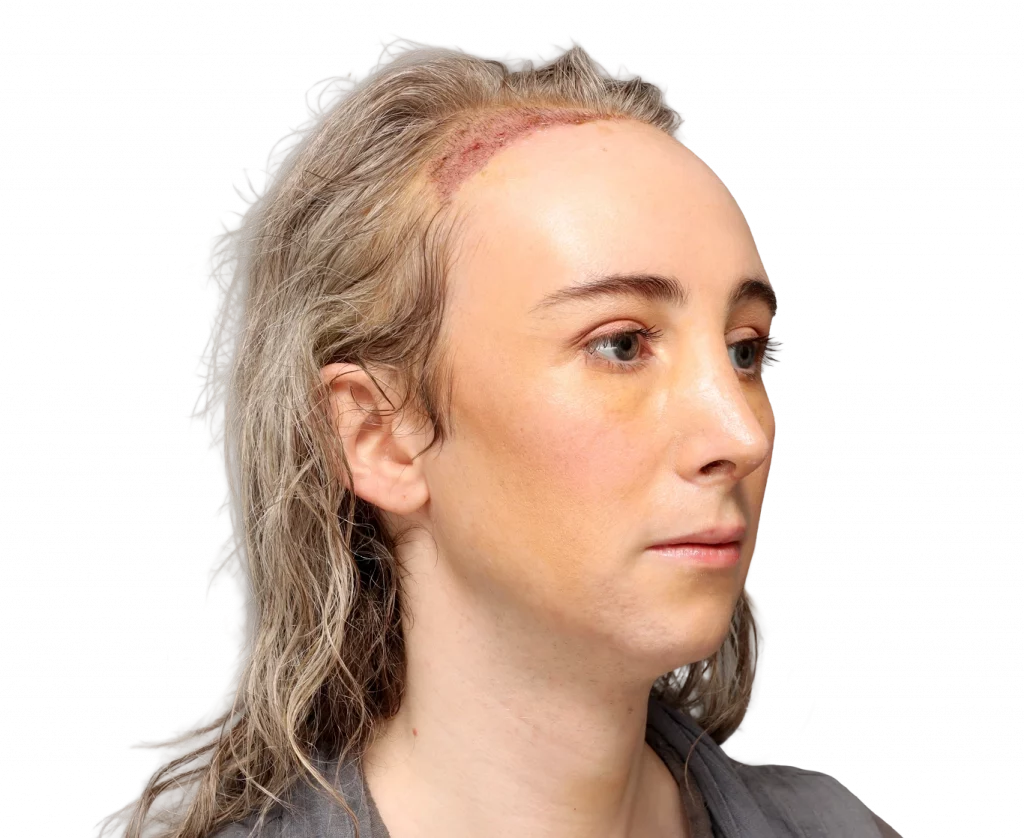 Angled right profile photo of Hayley after surgery.