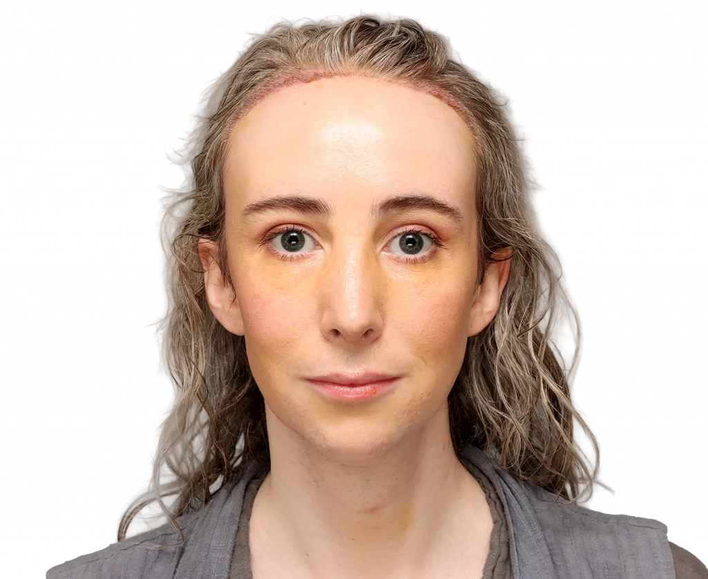 Front profile photo of Hayley after surgery.