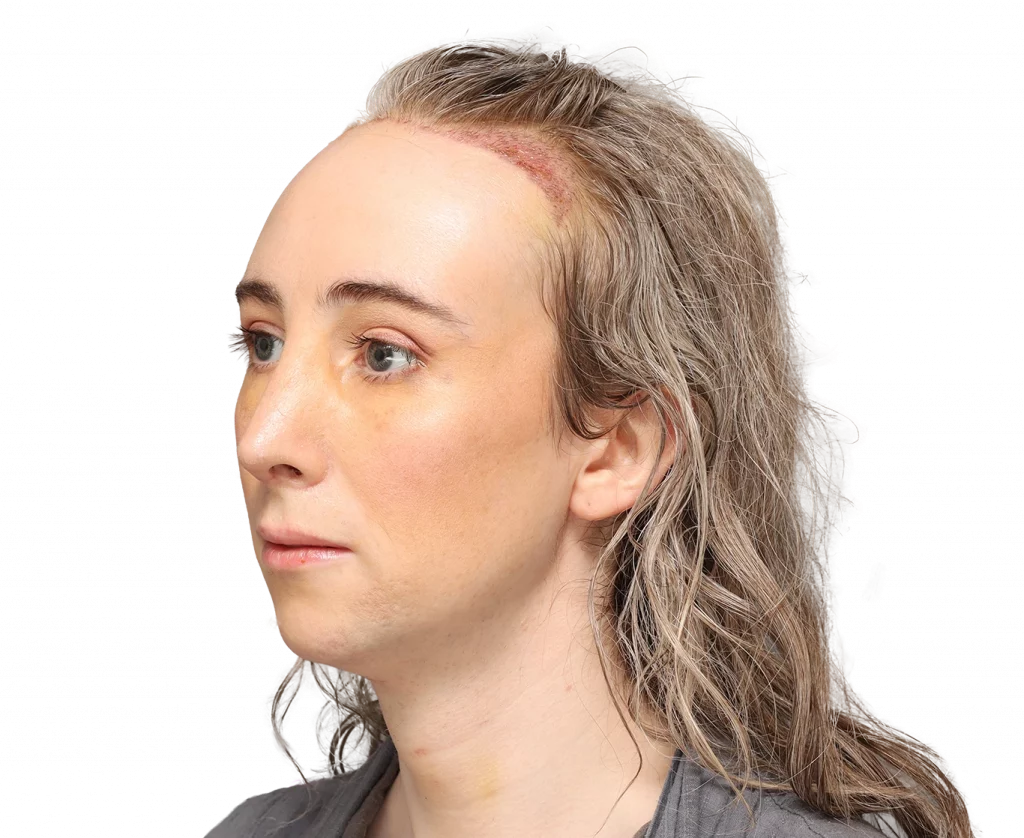 Angled profile photo of Hayley after surgery.