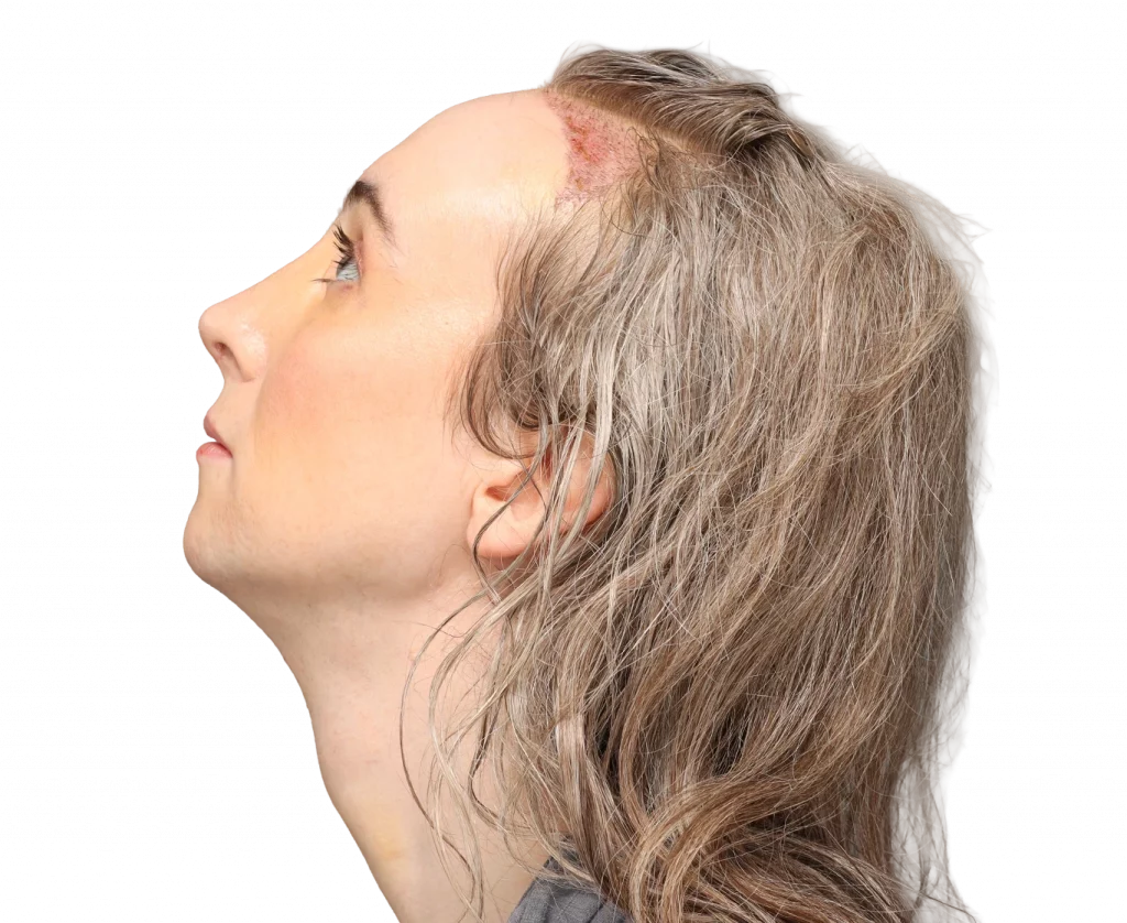 Side up profile photo of Hayley after surgery.