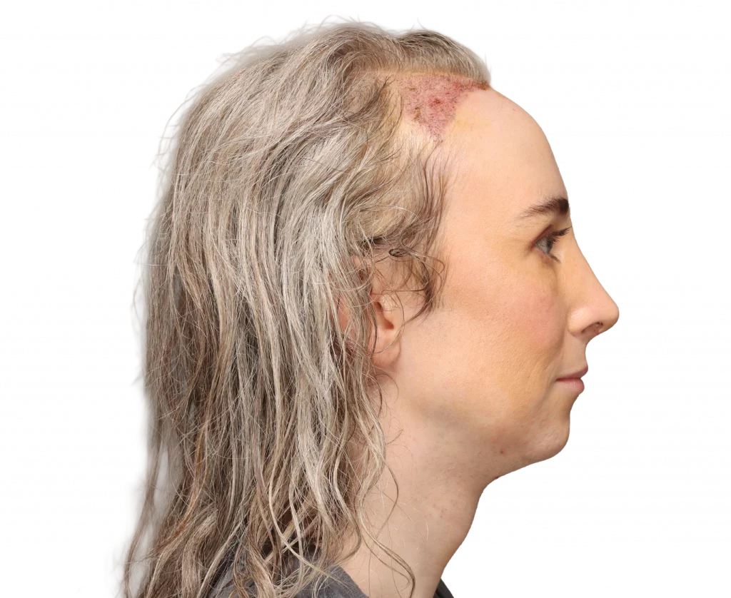 Side right profile photo of Hayley after surgery.