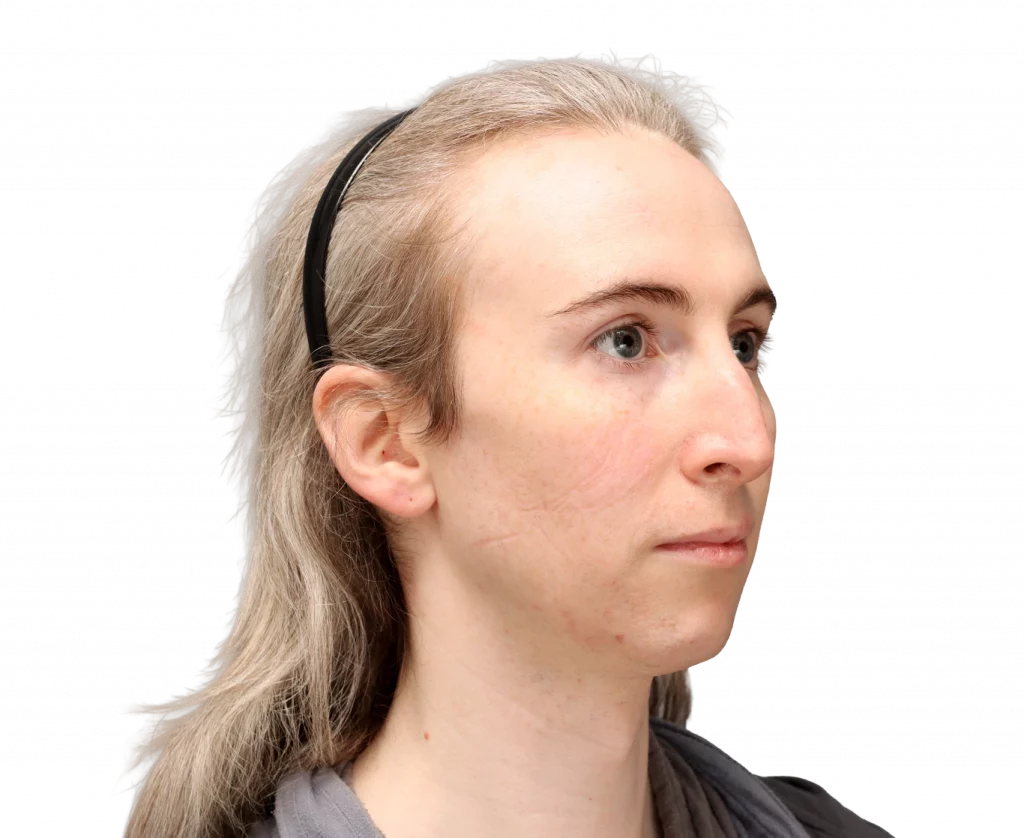 Angled right profile photo of Hayley before surgery.