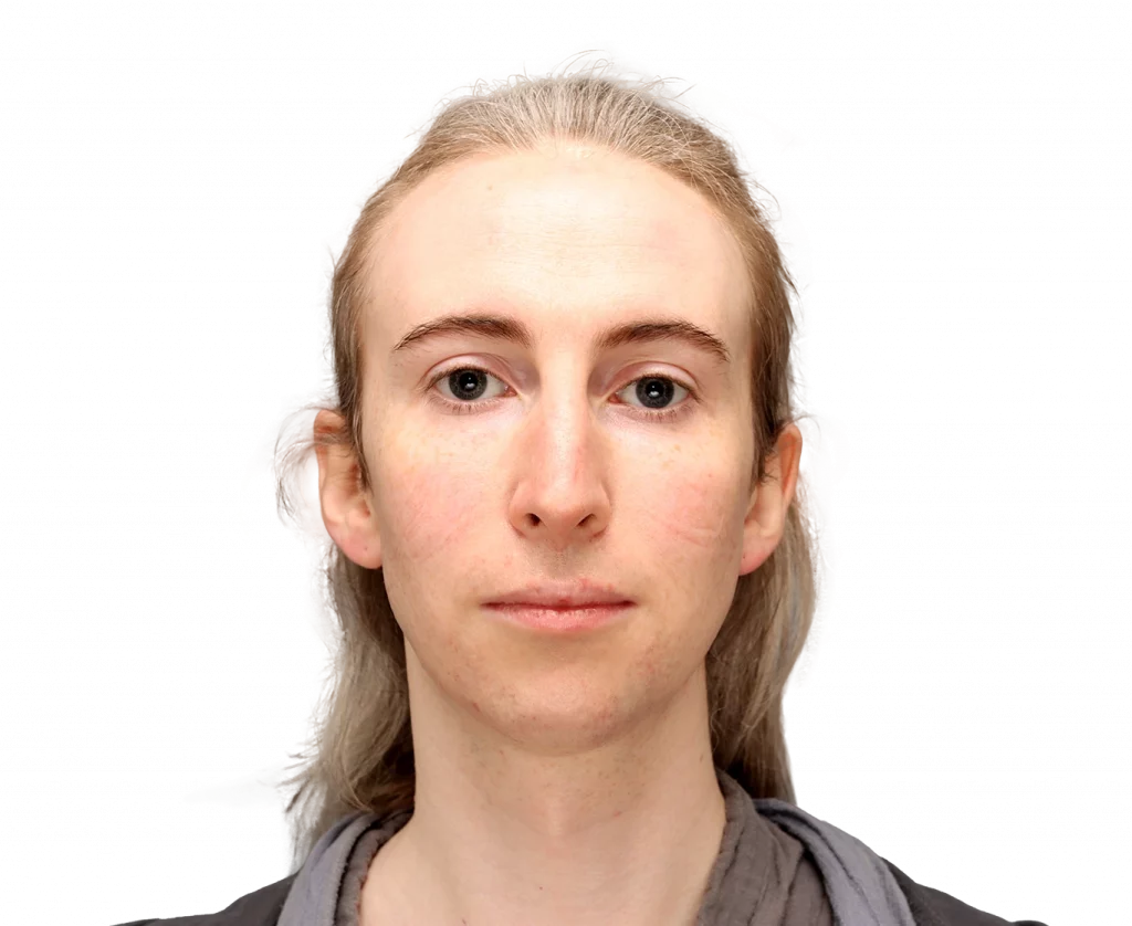 Front profile photo of Hayley before surgery.