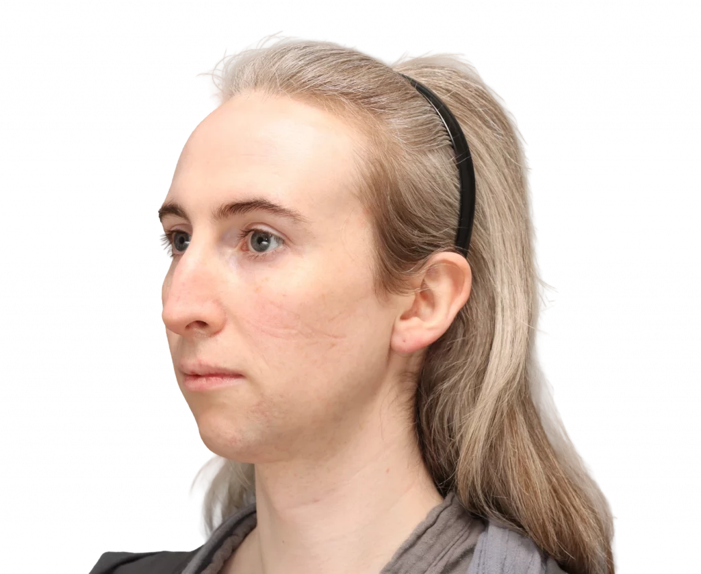 Angled left profile photo of Hayley before surgery.