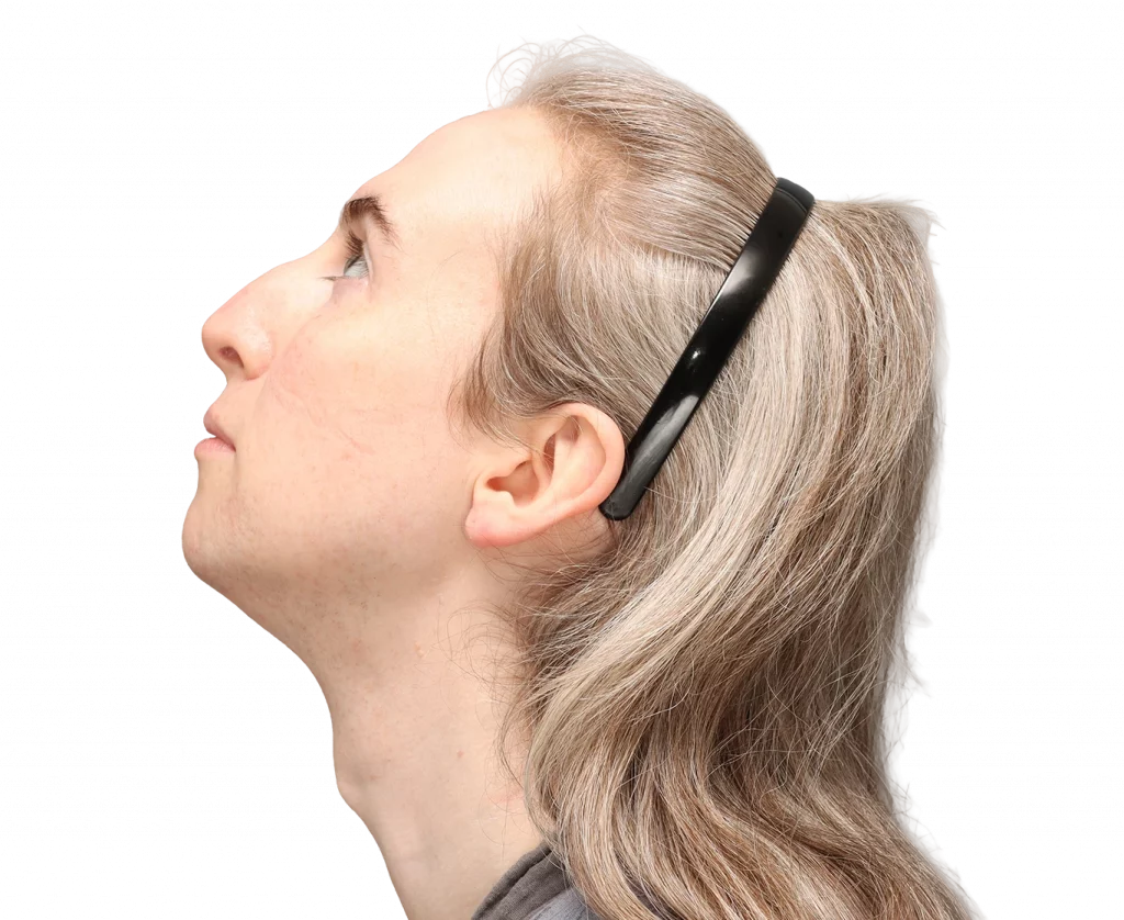 Side up left profile photo of Hayley before surgery.