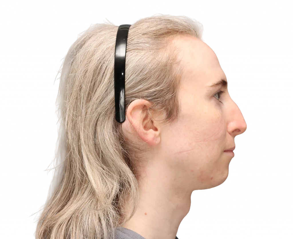 Side right profile photo of Hayley before surgery.