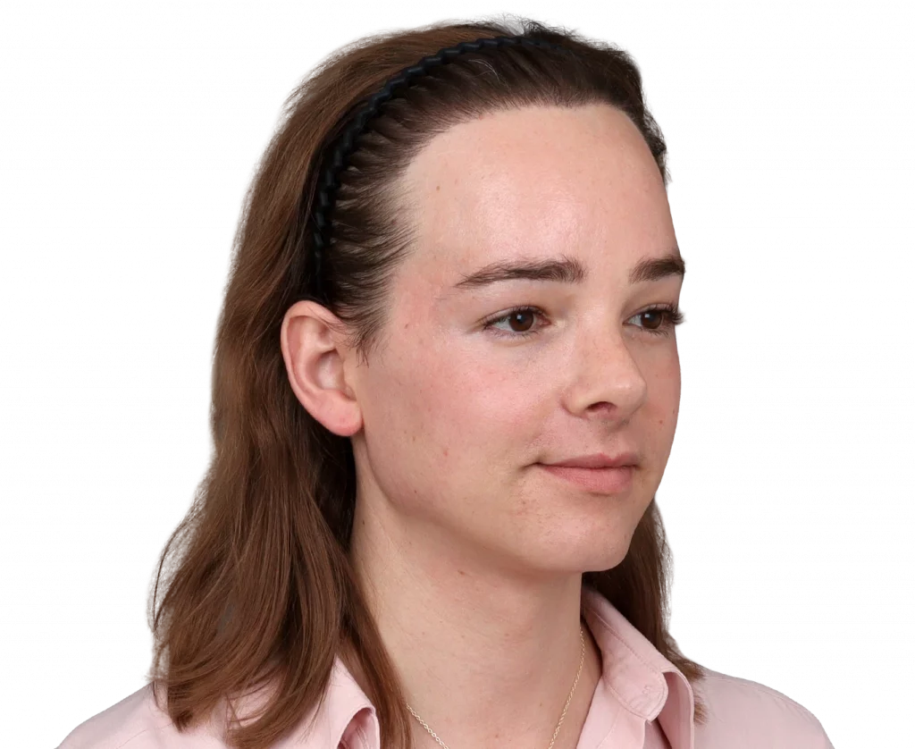 Angled right profile photo of Lilly Nea after surgery.