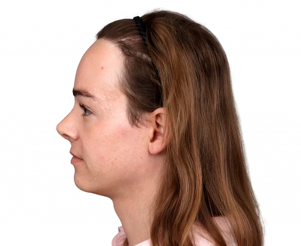 Side left profile photo of Lilly Nea after surgery.