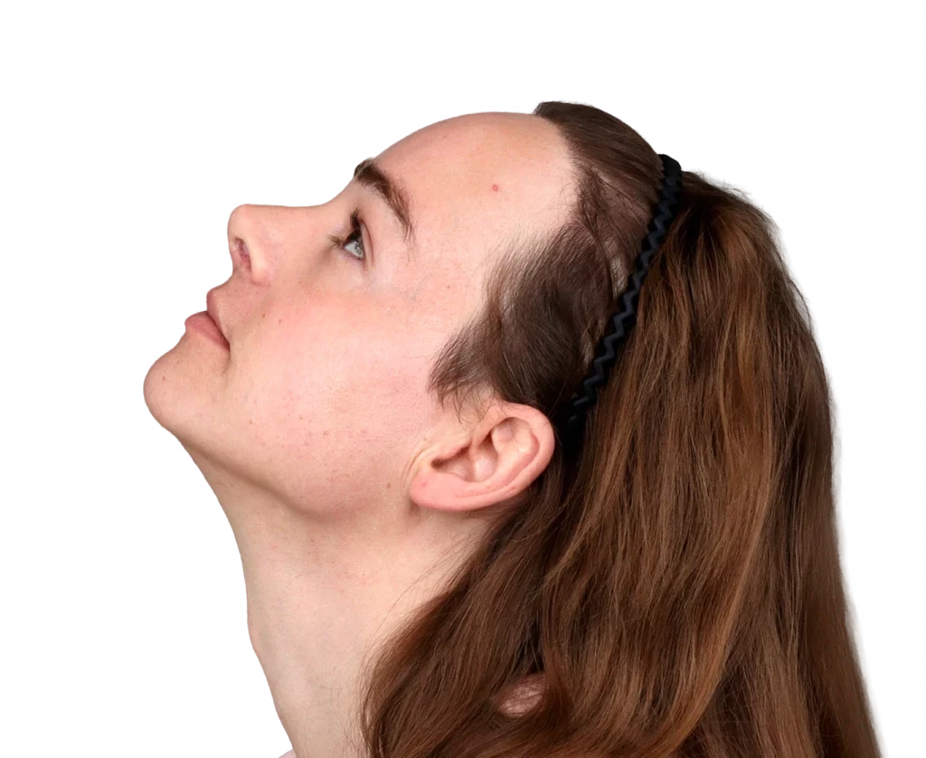 Side up left profile photo of Lilly Nea after surgery.