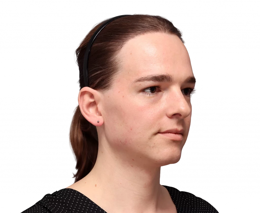 Angled right profile photo of Lilly Nea before surgery.