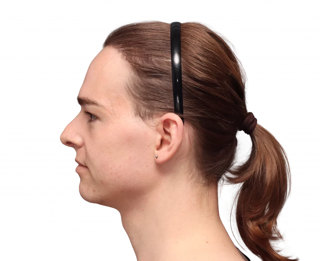 Side left profile photo of Lilly Nea before surgery.