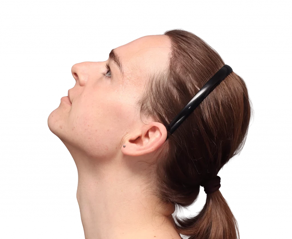 Side up left profile photo of Lilly Nea before surgery.