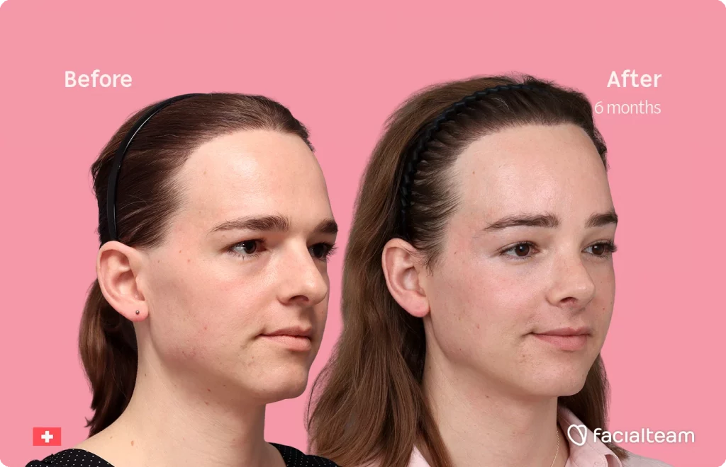 Angled right image of FFS patient Lilly Nea showing the results before-after with Facialteam consisting of Forehead and Nose Feminization Feminization surgery.