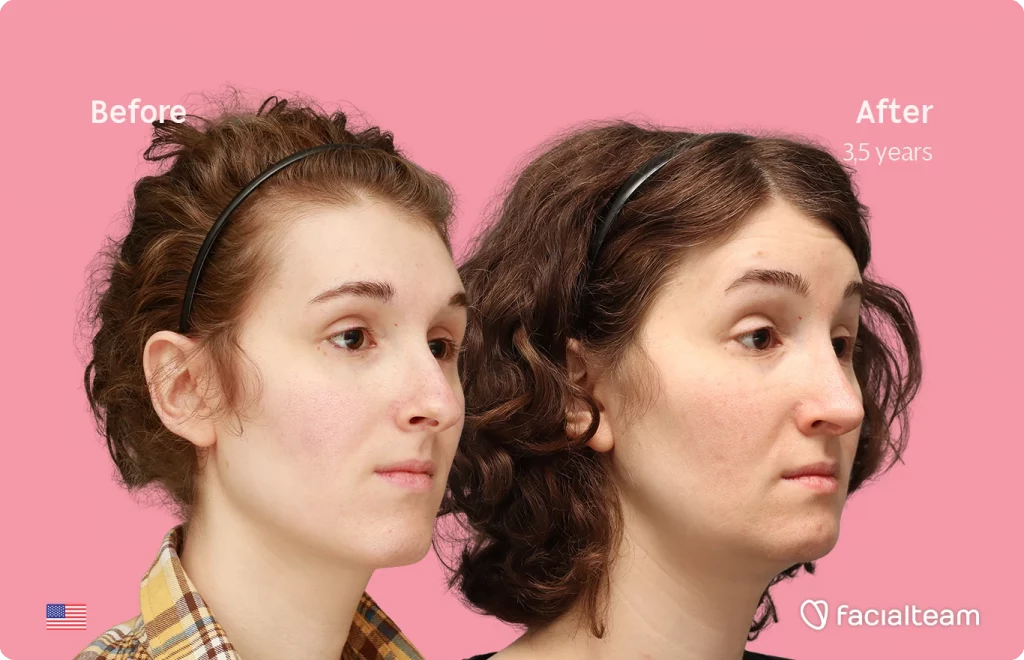 Angled right image of FFS patient Arly G. showing the results before-after with Facialteam consisting of Forehead, Nose Feminization, Jaw and Chin Feminization surgery.
