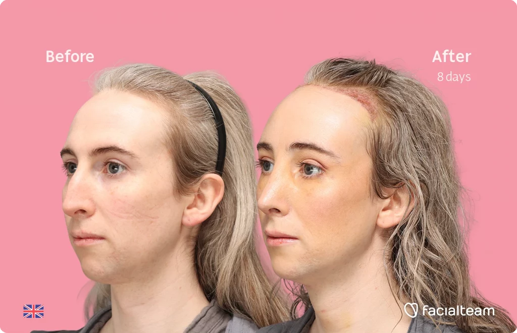 Angled left image of FFS patient Hayley C. showing the results before-after with Facialteam consisting of Forehead with SHT, Nose Feminization, and Tracheal Shave Feminization surgery.