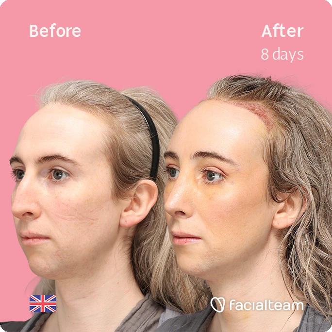 Angled left square image of FFS patient Hayley C. showing the results before-after with Facialteam consisting of Forehead with SHT, Nose Feminization, and Tracheal Shave Feminization surgery.