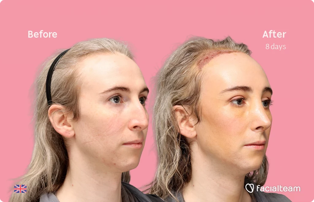 Angled right image of FFS patient Hayley C. showing the results before-after with Facialteam consisting of Forehead with SHT, Nose Feminization, and Tracheal Shave Feminization surgery.