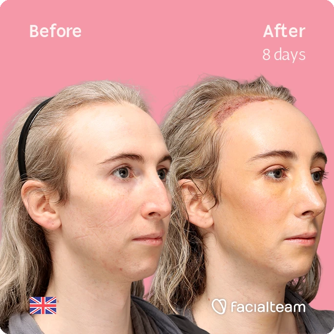 Angled right square image of FFS patient Hayley C. showing the results before-after with Facialteam consisting of Forehead with SHT, Nose Feminization, and Tracheal Shave Feminization surgery.