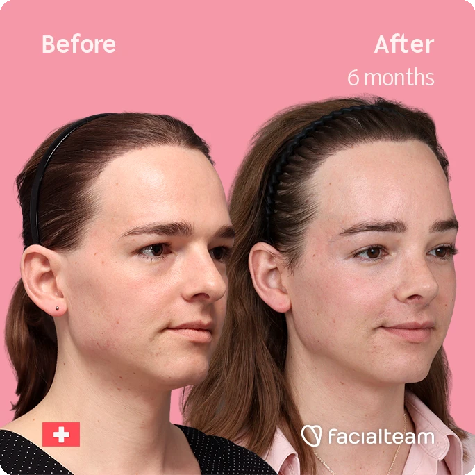 Angled right square image of FFS patient Lilly Nea showing the results before-after with Facialteam consisting of Forehead and Nose Feminization Feminization surgery.
