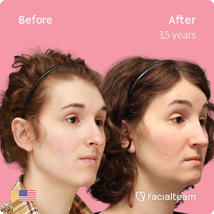 Angled right square image of FFS patient Arly G. showing the results before-after with Facialteam consisting of Forehead, Nose Feminization, Jaw and Chin Feminization surgery.