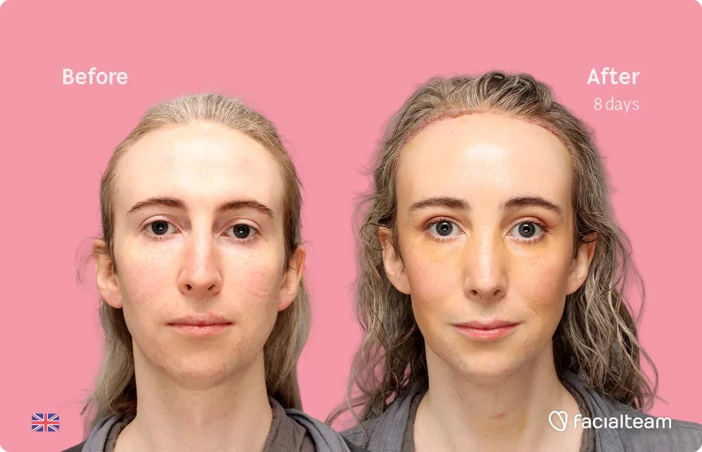 Front image of FFS patient Hayley C. showing the results before-after with Facialteam consisting of Forehead with SHT, Nose Feminization, and Tracheal Shave Feminization surgery.
