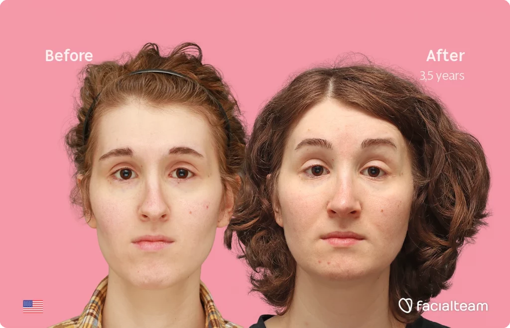 Front image of FFS patient Arly G. showing the results before-after with Facialteam consisting of Forehead, Nose Feminization, Jaw and Chin Feminization surgery.