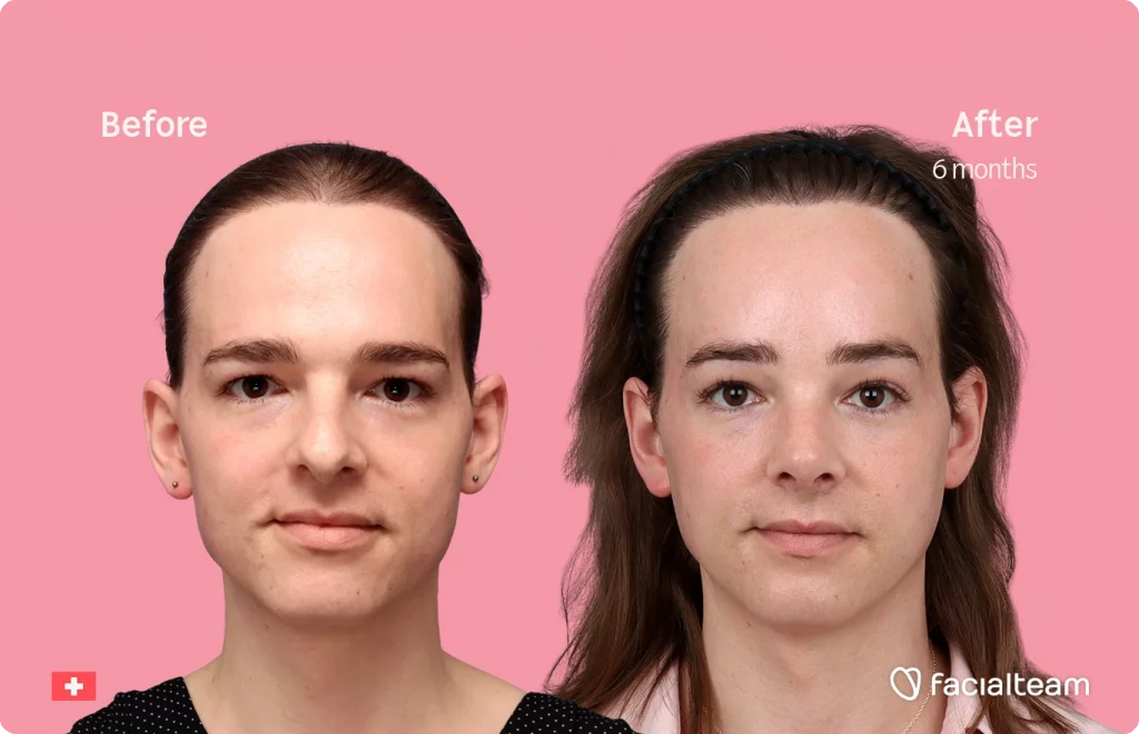 Front image of FFS patient Lilly Nea showing the results before-after with Facialteam consisting of Forehead and Nose Feminization Feminization surgery.