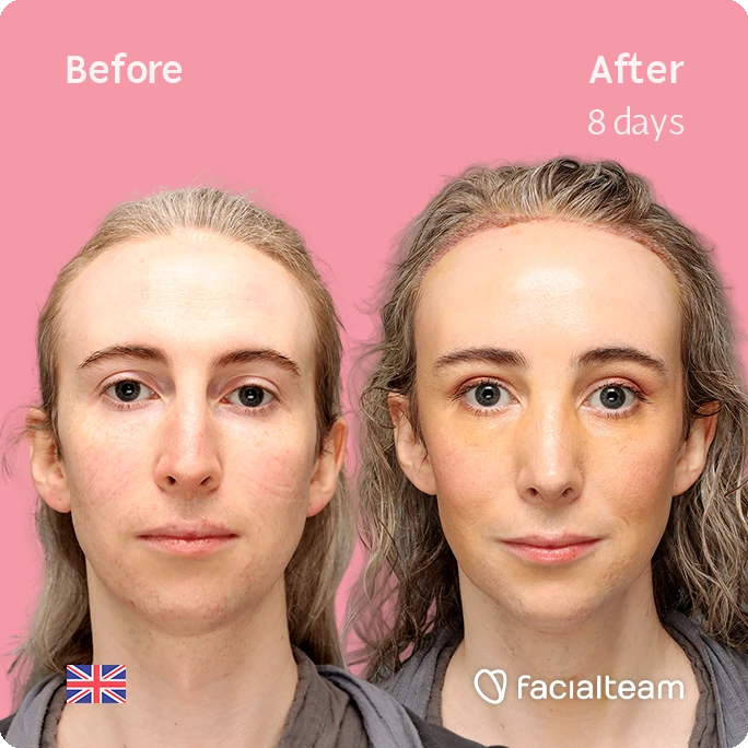 Front square image of FFS patient Hayley C. showing the results before-after with Facialteam consisting of Forehead with SHT, Nose Feminization, and Tracheal Shave Feminization surgery.
