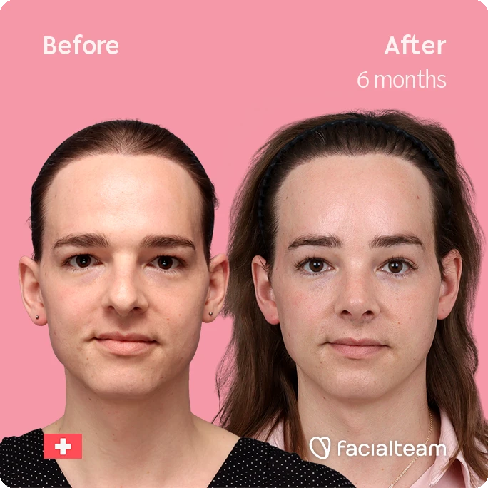 Front square image of FFS patient Lilly Nea showing the results before-after with Facialteam consisting of Forehead and Nose Feminization Feminization surgery.