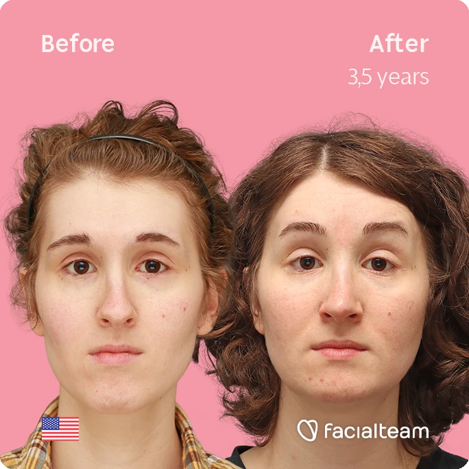 Front square image of FFS patient Arly G. showing the results before-after with Facialteam consisting of Forehead, Nose Feminization, Jaw and Chin Feminization surgery.