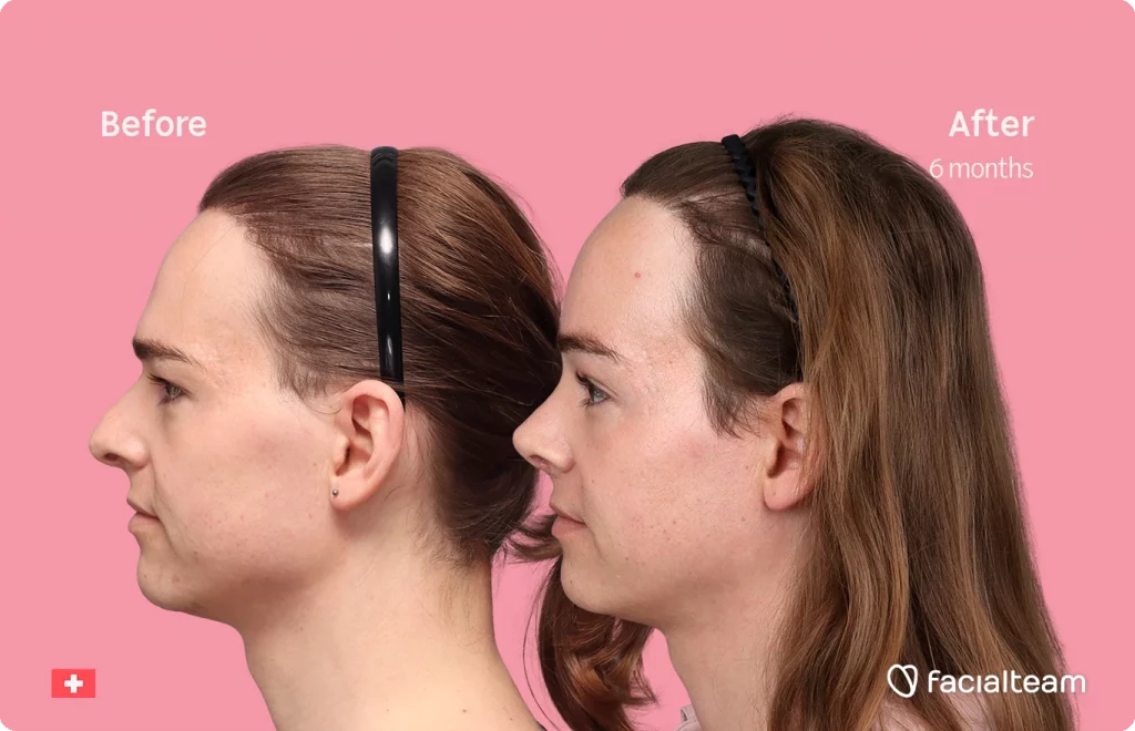 Angled left image of FFS patient Lilly Nea showing the results before-after with Facialteam consisting of Forehead and Nose Feminization Feminization surgery.