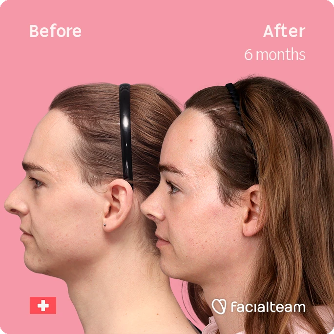 Side left square image of FFS patient Lilly Nea showing the results before-after with Facialteam consisting of Forehead and Nose Feminization Feminization surgery.