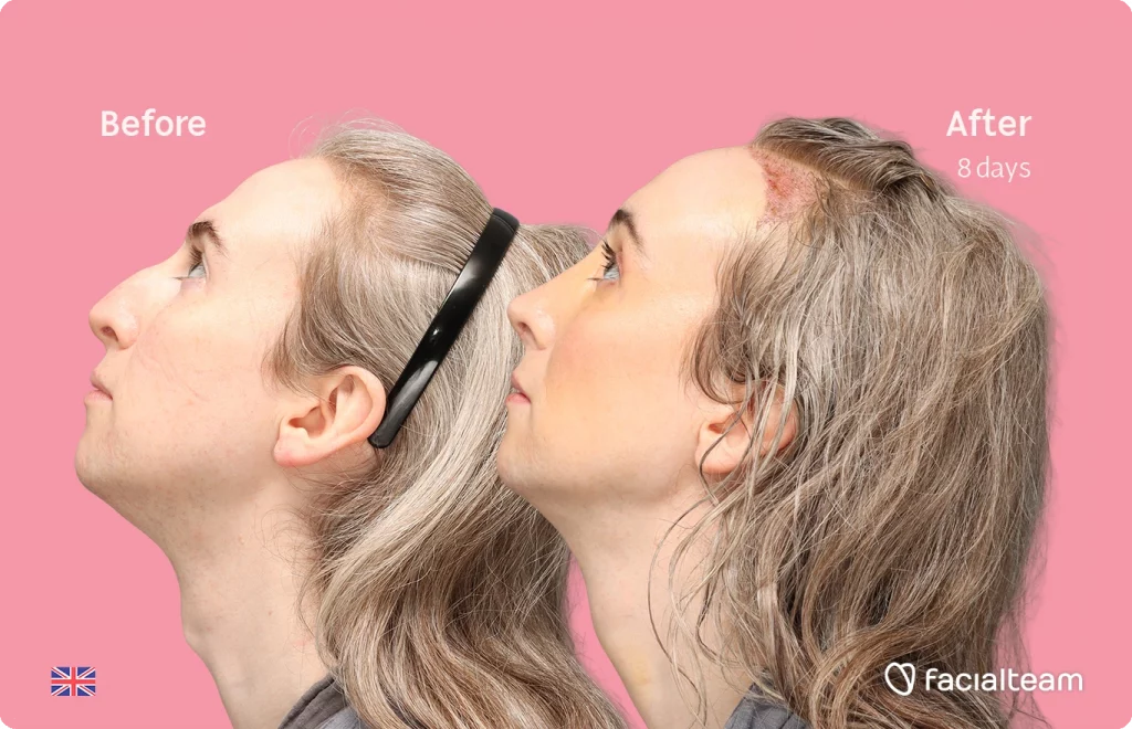 Side up left image of FFS patient Hayley C. showing the results before-after with Facialteam consisting of Forehead with SHT, Nose Feminization, and Tracheal Shave Feminization surgery.