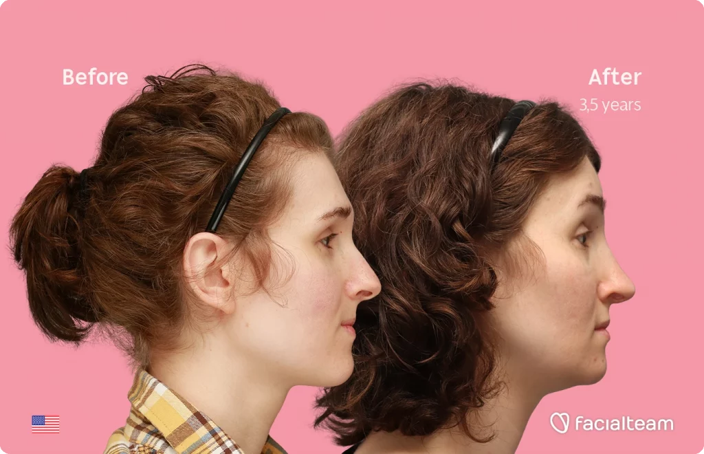 Side right image of FFS patient Arly G. showing the results before-after with Facialteam consisting of Forehead, Nose Feminization, Jaw and Chin Feminization surgery.