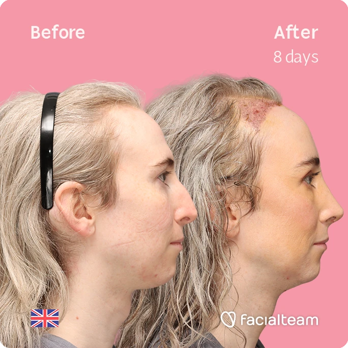 Side right square image of FFS patient Hayley C. showing the results before-after with Facialteam consisting of Forehead with SHT, Nose Feminization, and Tracheal Shave Feminization surgery.