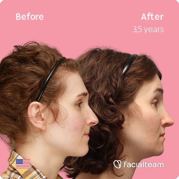 Side right square image of FFS patient Arly G. showing the results before-after with Facialteam consisting of Forehead, Nose Feminization, Jaw and Chin Feminization surgery.