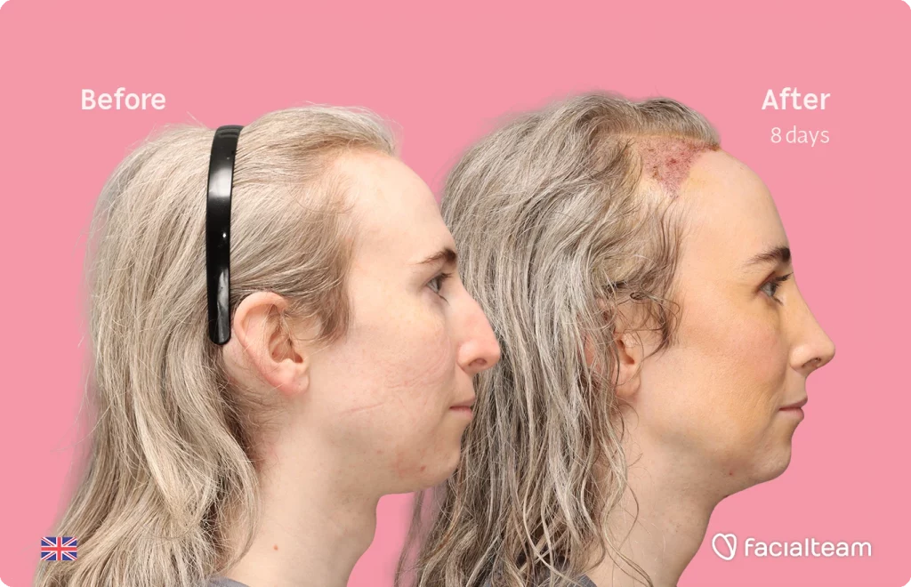 Side right image of FFS patient Hayley C. showing the results before-after with Facialteam consisting of Forehead with SHT, Nose Feminization, and Tracheal Shave Feminization surgery.