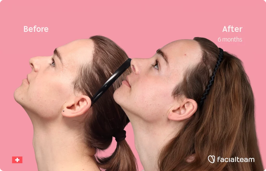 Side left up image of FFS patient Lilly Nea showing the results before-after with Facialteam consisting of Forehead and Nose Feminization Feminization surgery.