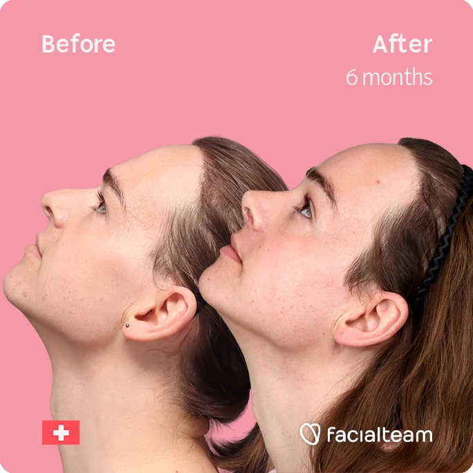 Side up left square image of FFS patient Lilly Nea showing the results before-after with Facialteam consisting of Forehead and Nose Feminization Feminization surgery.