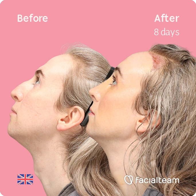 Side up left square image of FFS patient Hayley C. showing the results before-after with Facialteam consisting of Forehead with SHT, Nose Feminization, and Tracheal Shave Feminization surgery.