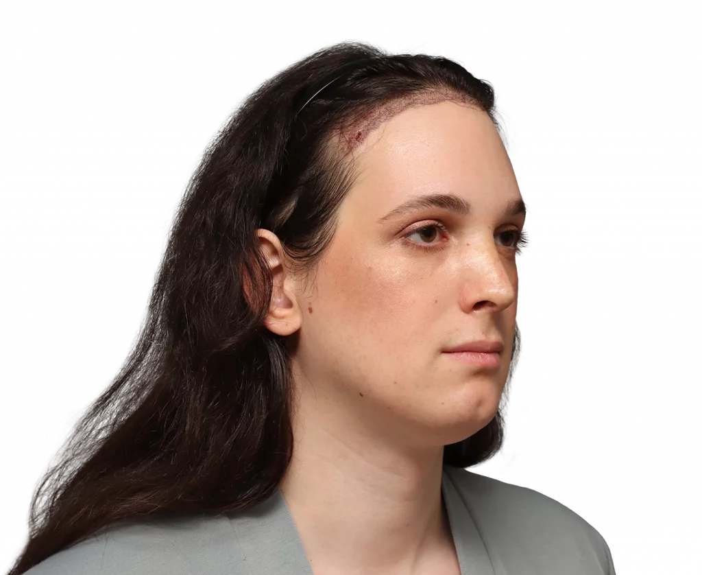 Angled right profile photo of Fiore after surgery.