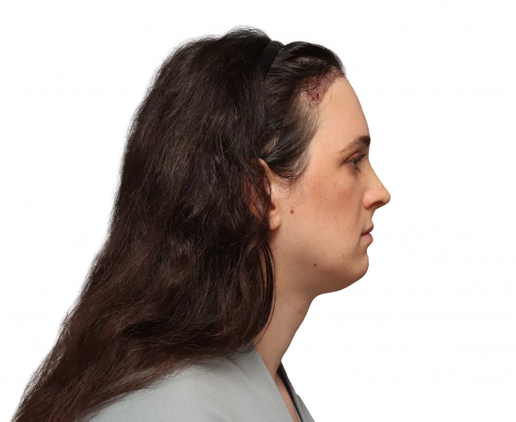 Side right profile photo of Fiore after surgery.