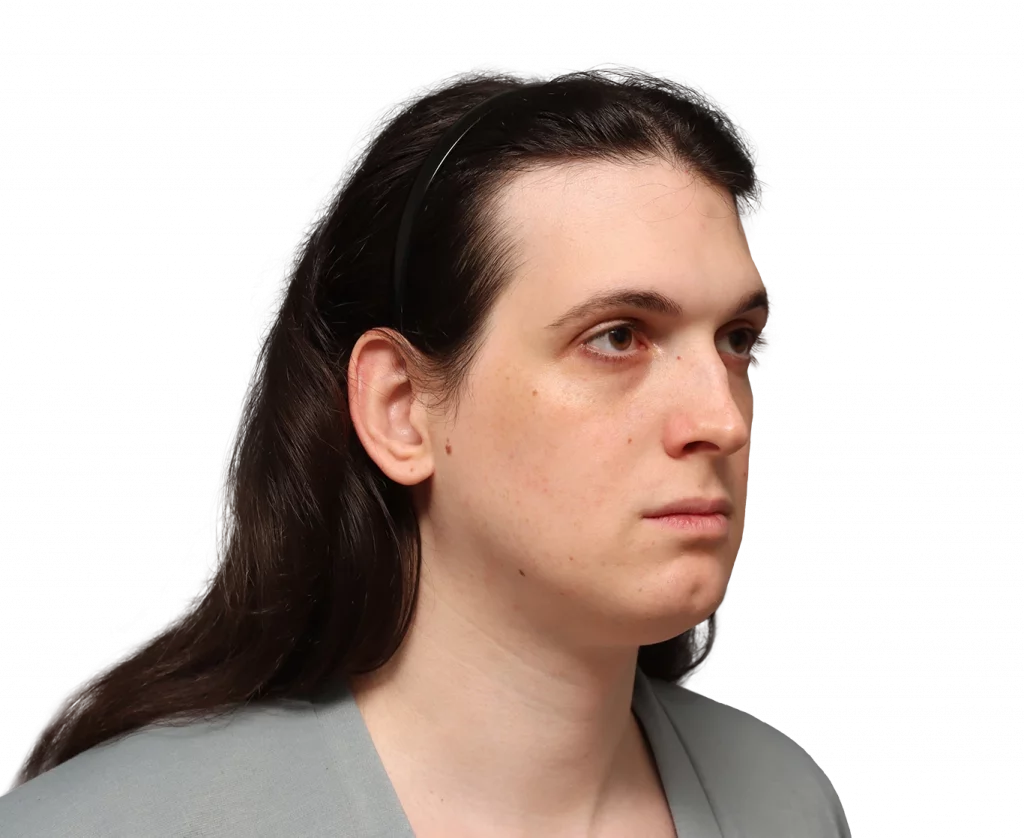 Angled right profile photo of Fiore before surgery.