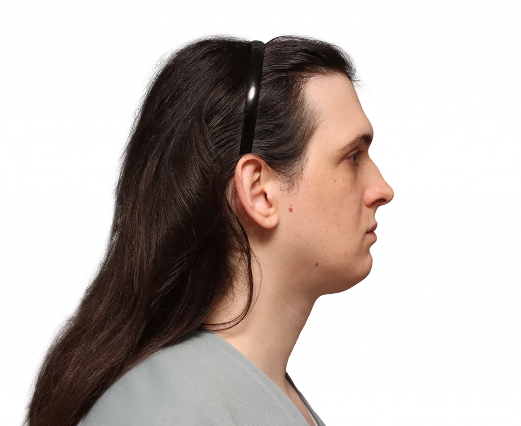 Side right profile photo of Fiore before surgery.