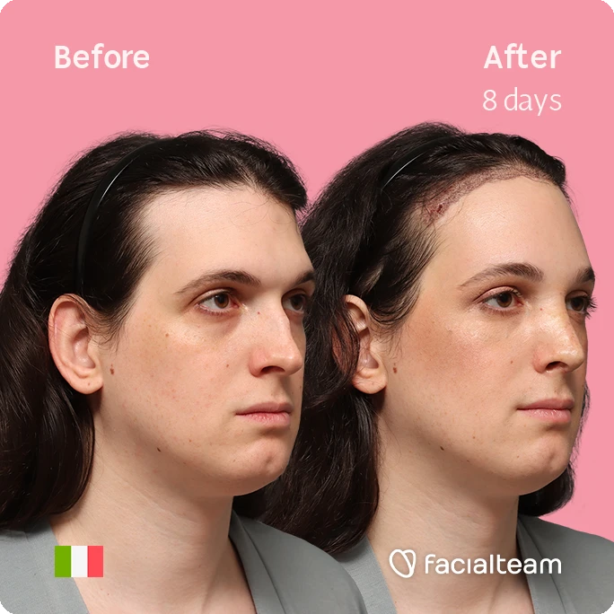 Angled right square image of FFS patient Fiore showing the results before-after with Facialteam consisting of Forehead with SHT and rhinoplasty Feminization surgery.