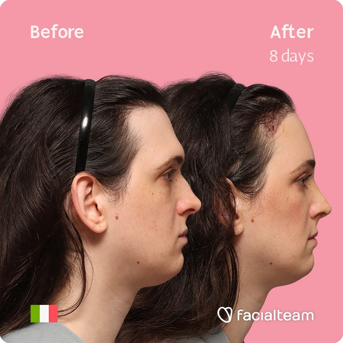 Side right square image of FFS patient Fiore showing the results before-after with Facialteam consisting of Forehead with SHT and rhinoplasty Feminization surgery.