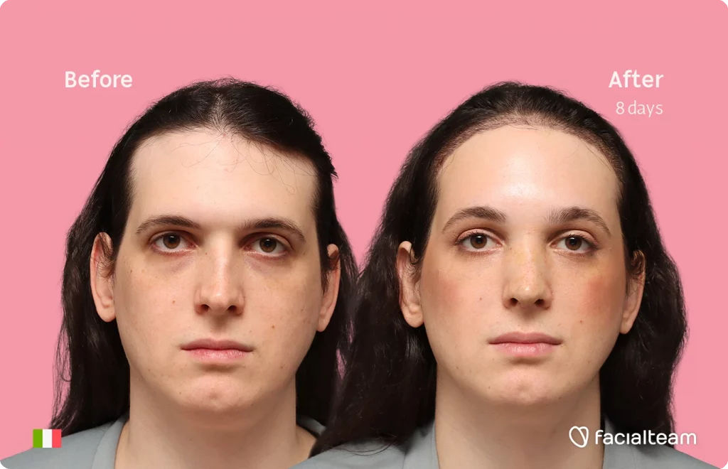 Frontal image of FFS patient Fiore showing the results before-after with Facialteam consisting of Forehead with SHT and rhinoplasty Feminization surgery.