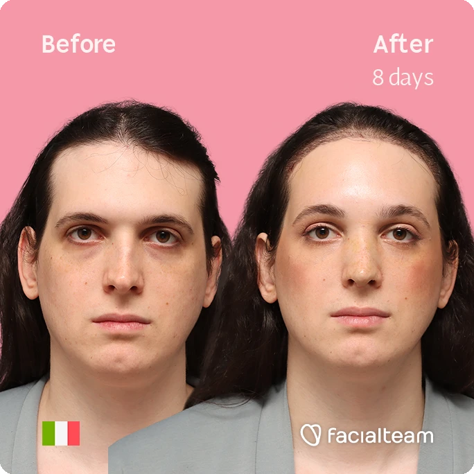Frontal square image of FFS patient Fiore showing the results before-after with Facialteam consisting of Forehead with SHT and rhinoplasty Feminization surgery.