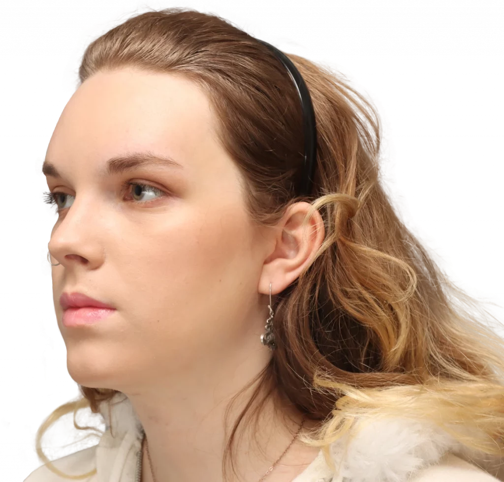 Angled left profile photo of Lilly C. after surgery.