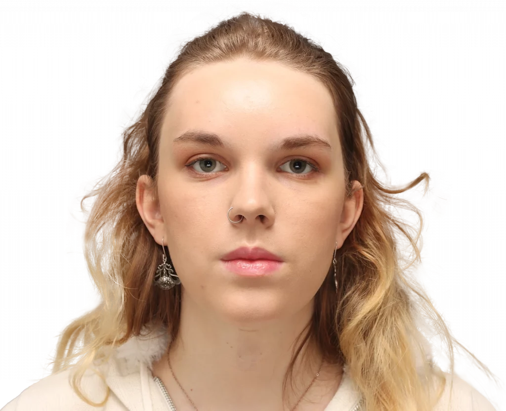 Front profile photo of Lilly C. after surgery.